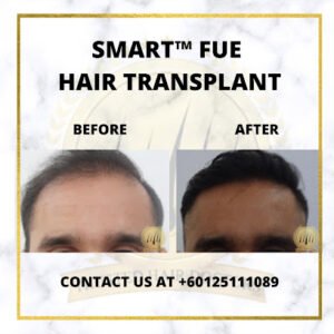 SMART FUE Hair Transplant